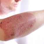 https://nazdravlje.hr/dermatologija/psorijaza-sve-sto-trebate-znati-o-simptomima-vrstama-razlikama-i-lijecenju