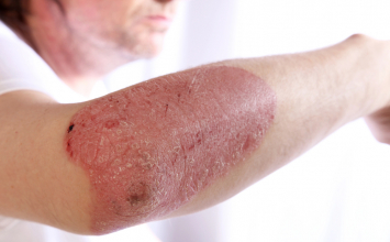 Psorijaza: Sve što trebate znati o simptomima, vrstama, razlikama i liječenju