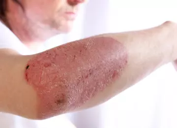 Psorijaza: Sve što trebate znati o simptomima, vrstama, razlikama i liječenju