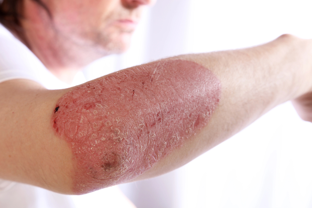 Psorijaza: Sve što trebate znati o simptomima, vrstama, razlikama i liječenju
