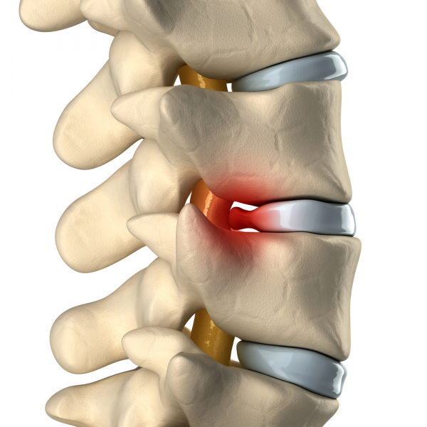 Hernija diska simptomi