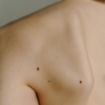 https://nazdravlje.hr/dermatologija/test-madeza