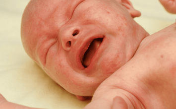 Najčešće alergije kod beba i djece te kako ih prepoznati