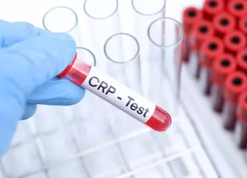 Povišen CRP: što znači nalaz, uzroci povišenja i kako ga smanjiti