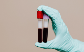 Trombofilija: tihi ubojica koji utječe na trudnoće i napada srce