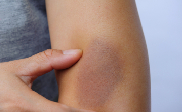 Modrice bez udarca: kada treba napraviti krvne pretrage