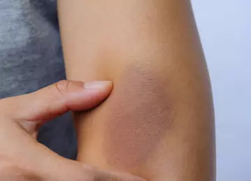 Modrice bez udarca: kada treba napraviti krvne pretrage