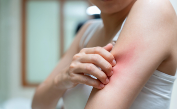 Ubod pčele, ose ili komarca: kada je reakcija normalna, a kada opasna