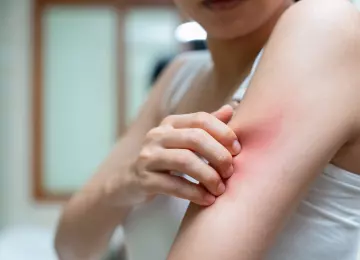 Ubod pčele, ose ili komarca: kada je reakcija normalna, a kada opasna